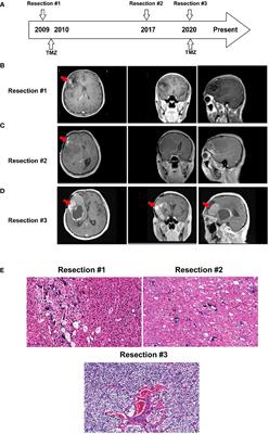 Case report: ISL2 is involved in malignant transformation in a patient with multiple relapsed oligodendroglioma